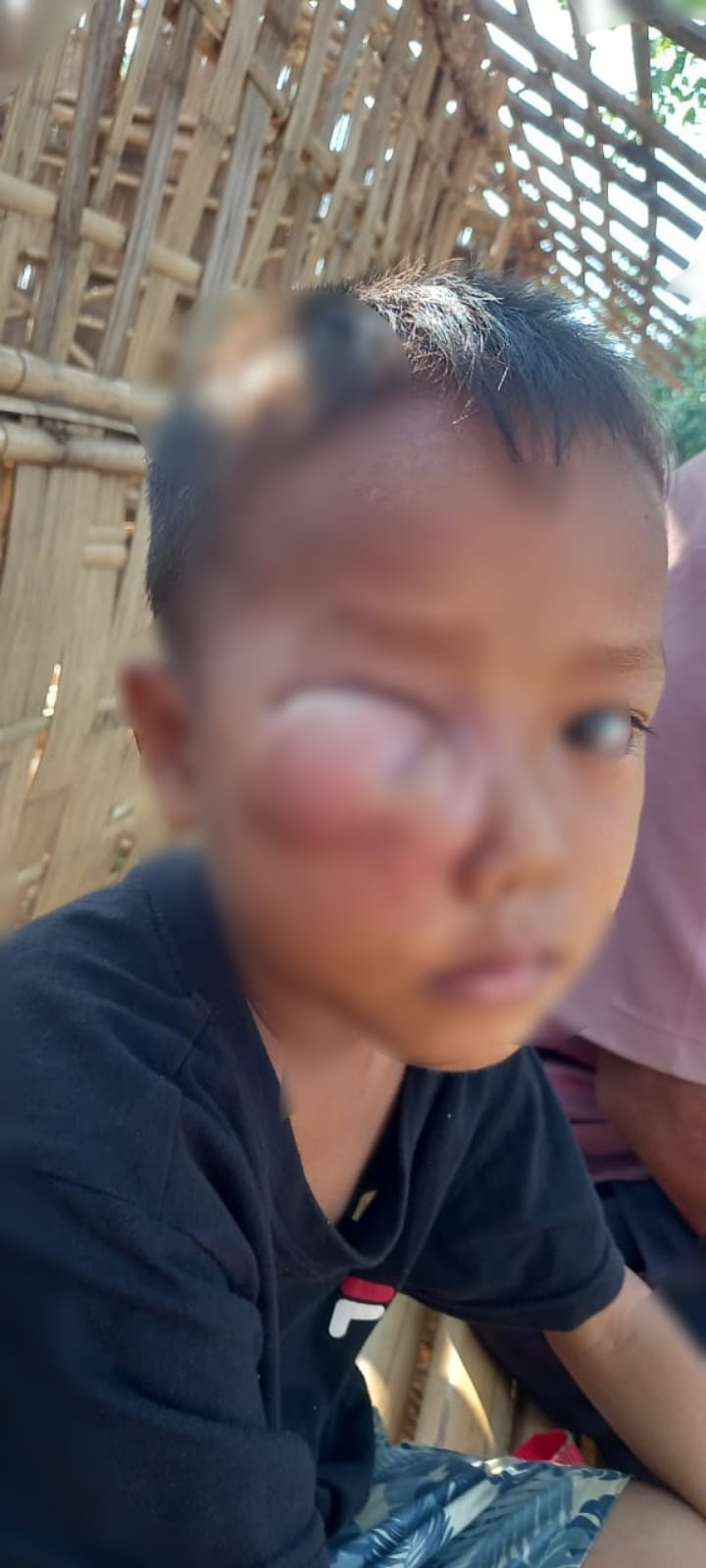 সেনাবাহিনীর তাৎক্ষণিক হস্তক্ষেপে রক্ষা পেল পাহাড়ি শিশুর চোখ
